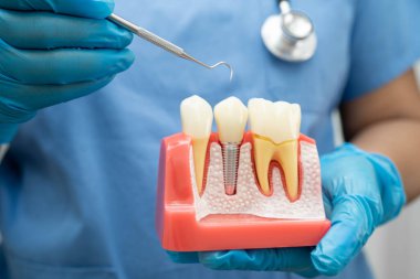 Diş implantı tutan diş hekimi, çeneye yapay diş kökleri, diş tedavisi kanal tedavisi, diş eti hastalığı, dişçi için diş modeli.