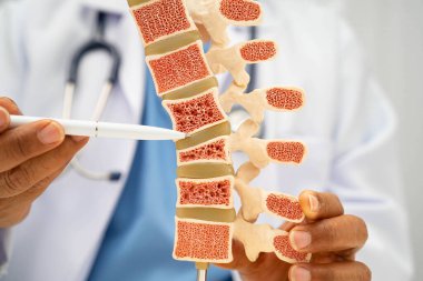 Doktor, ortopedi bölümünde tedavi için kemik modelinde osteoporoz tutuyor..