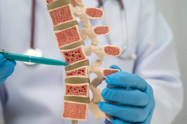 Doktor, ortopedi bölümünde tedavi için kemik modelinde osteoporoz tutuyor..