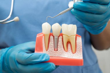 Diş implantı tutan diş hekimi, çeneye yapay diş kökleri, diş tedavisi kanal tedavisi, diş eti hastalığı, dişçi için diş modeli.