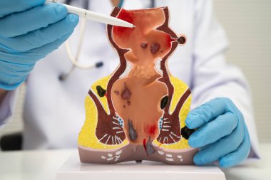 Hastanede rektum ve hemoroit insan anatomisi modeli olan Asyalı bir doktor vasküler yapısında iltihaplanma var..