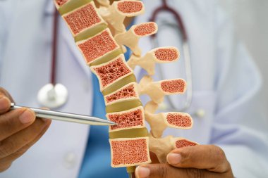 Doktor, ortopedi bölümünde tedavi için kemik modelinde osteoporoz tutuyor..