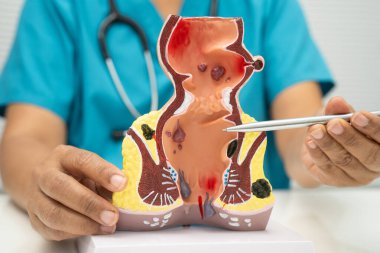 Hastanede rektum ve hemoroit insan anatomisi modeli olan Asyalı bir doktor vasküler yapısında iltihaplanma var..