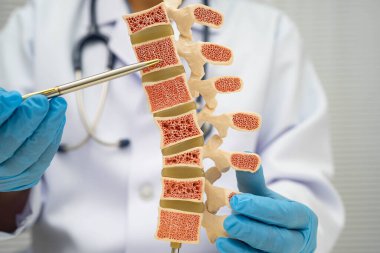 Doktor, ortopedi bölümünde tedavi için kemik modelinde osteoporoz tutuyor..