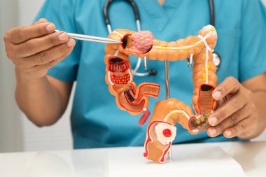 Renkli kanser, bağırsak bağırsağı tutan doktor insan anatomisi modeli..