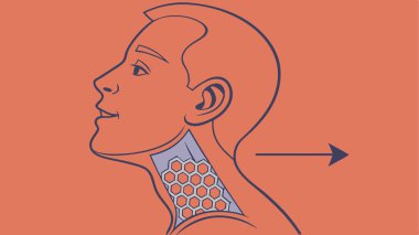 Detailed medical illustration showing the precise placement of a tracheostomy tube in the human neck. This anatomical diagram highlights the surgical procedure and its impact on the airway, offering educational insight into critical respiratory care.