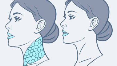See a clear before and after comparison of a neck lift procedure. This illustration highlights how cosmetic surgery can enhance jawline definition and improve the neck profile, leading to a more youthful and refined appearance.