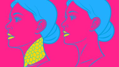 A clear medical illustration visually contrasts a healthy normal thyroid gland with an enlarged, nodular thyroid, representing common thyroid health conditions. This diagram helps explain anatomical differences in the endocrine system for educational