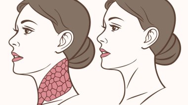 Medical illustration comparing a healthy thyroid gland with goiter enlargement. Visual guide for understanding neck conditions and symptoms.