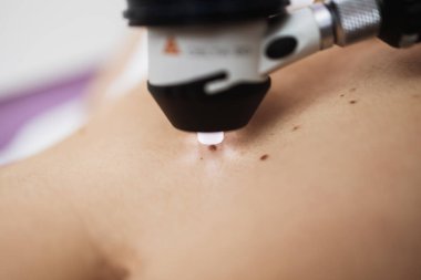 Close up shot of modern dermatology skin check up with digital deramatoscope. Dermoscopy microscope procedure and skin cancer prevention treatment.  clipart