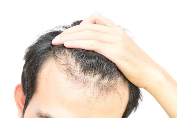 Closeup jovem homem grave problema de perda de cabelo para o conceito de perda de cabelo — Fotografia de Stock