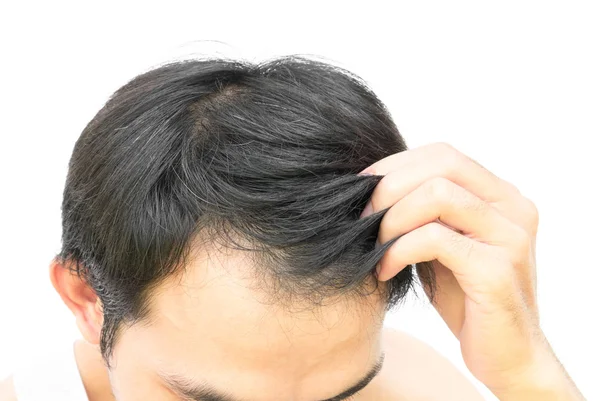 Closeup mladý muž vážné vlasy ztráta problém pro produkt vypadávání vlasů koncept nebo zdravotní péče šampon na bílém pozadí — Stock fotografie