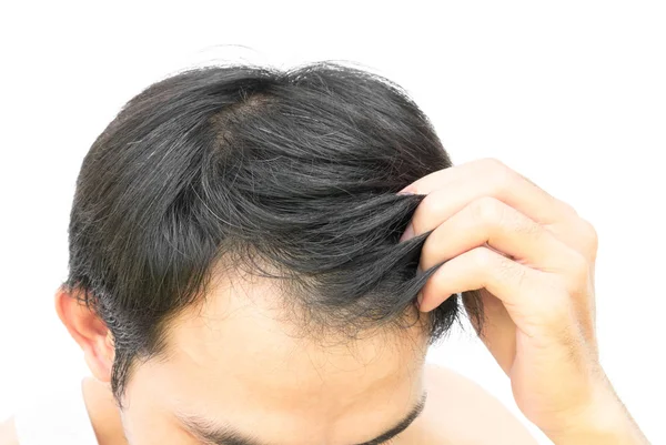 Primer plano joven serio problema de pérdida de cabello para el concepto de pérdida de cabello o productos de champú para el cuidado de la salud sobre fondo blanco —  Fotos de Stock