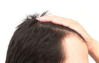Ciddi saç dökülmesi problemi saç kaybı konsepti için genç adam