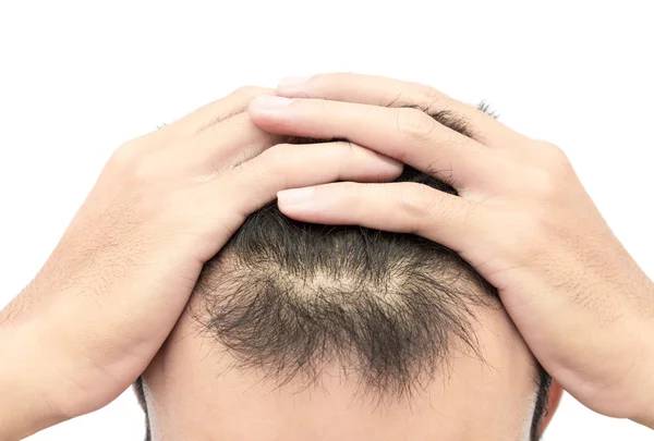 Vértes fiatalember komoly hajhullás problémáját haj veszteség koncepció — Stock Fotó