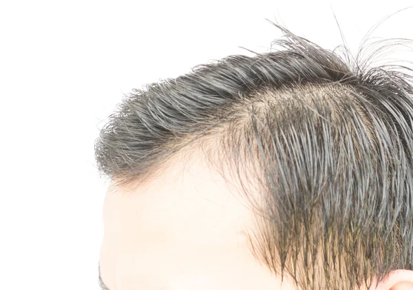 Młody mężczyzna problem utraty włosów poważne dla koncepcji wypadanie włosów — Zdjęcie stockowe