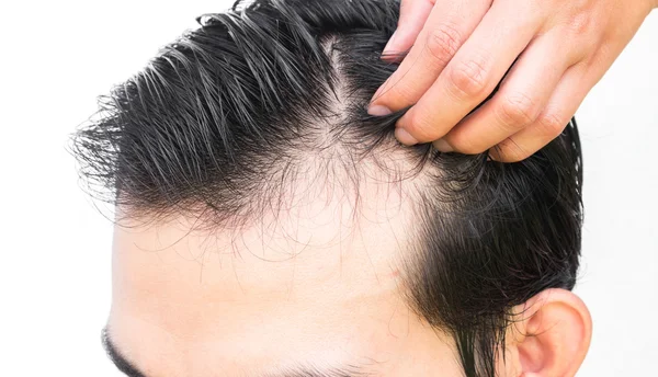 Closeup jovem homem grave problema de perda de cabelo para a perda de cabelo concep — Fotografia de Stock