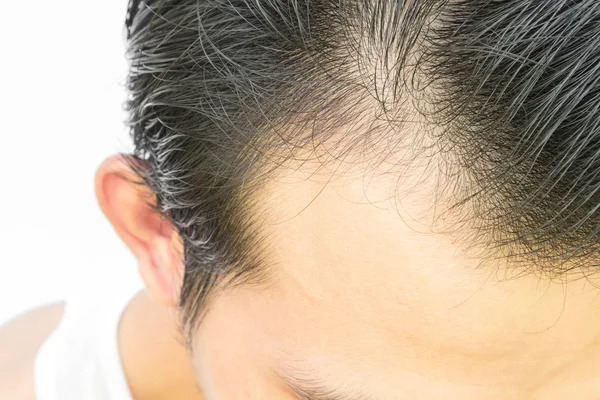 Joven hombre serio problema de pérdida de cabello para el concepto de pérdida de cabello —  Fotos de Stock