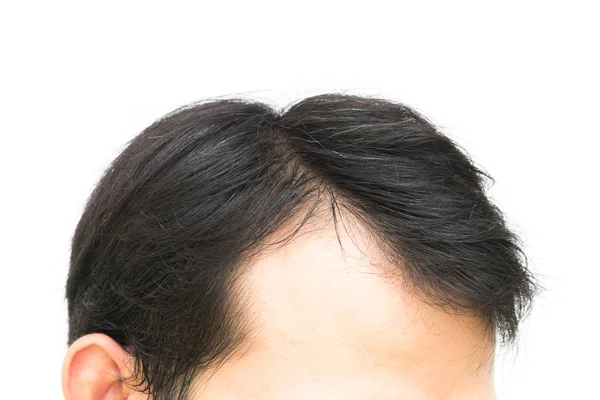 Closeup young man serious hair loss problem for hair loss concep — Stock Photo, Image
