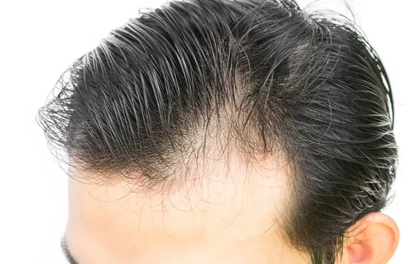 Giovane uomo grave problema di perdita di capelli per concetto di perdita di capelli — Foto Stock