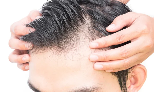 Young man serious hair loss problem for hair loss concept Stock Image