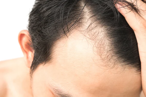 Joven hombre serio problema de pérdida de cabello para el concepto de pérdida de cabello — Foto de Stock