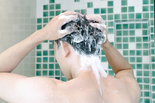 Junger Mann Ernstes Haarausfall Problem Für Gesundheitswesen Medizinisches Und Shampoo — Stockfoto