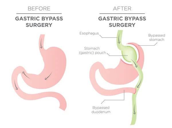 Žaludeční kapela hubnutí chirurgie. — Stockový vektor