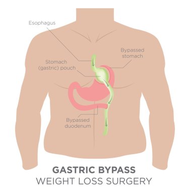 Kilo kaybı için Gastrik Bypass