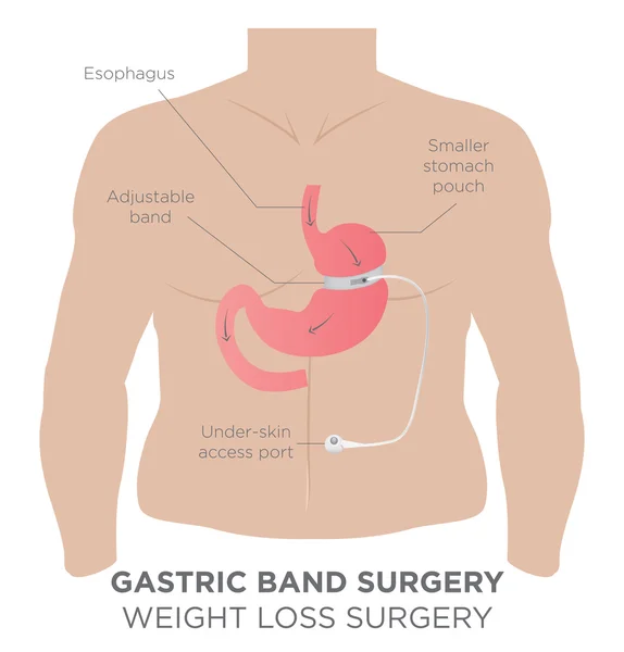 Žaludeční kapela hubnutí chirurgie — Stockový vektor