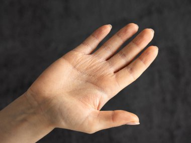 El egzaması yakın çekim. Dermatit olarak da bilinir. Çevresel koşullar nedeniyle kuru cilt. Derinin soyulması ve kabuğu kaşıntı ve acıya neden olur..