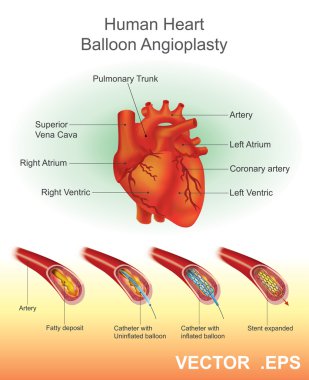 Human Heart Balloon Angioplasty. Vector Arts, illustration. clipart