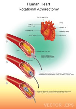  Atherectomy, Heart health, Vector design, Illustration. clipart