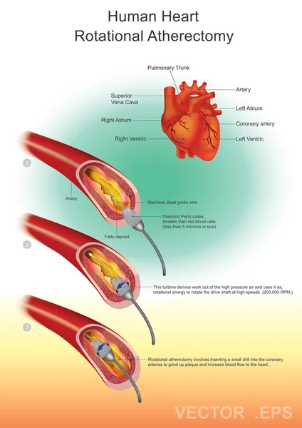 Athérectomie, Santé cardiaque, Conception vectorielle, Illustration . — Image vectorielle