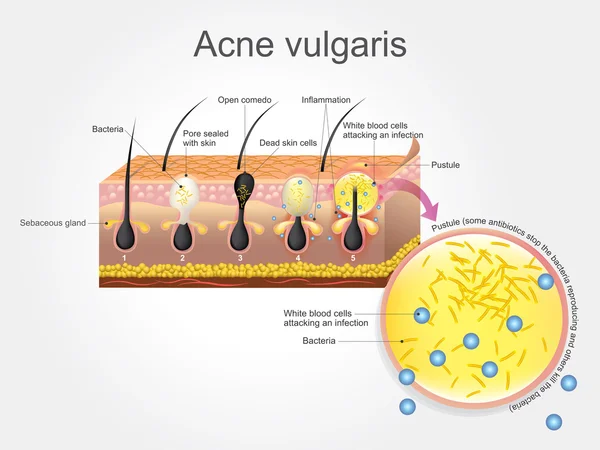 Acne Vulgaris. Artes vetoriais, ilustração . — Vetor de Stock