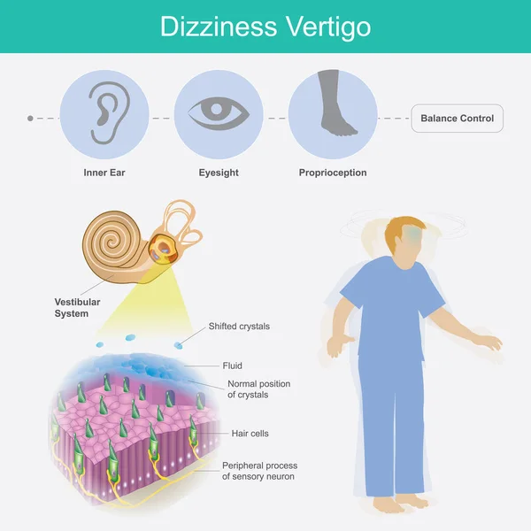 Duizeligheid Vertigo Illustratie Verklaren Duizeligheid Duizeligheid Door Oorzaak Van Kristallen — Stockvector