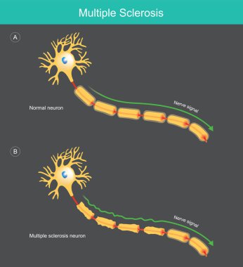 Çoklu skleroz. Tıbbi eğitimde anormal sinyalleri açıklamak için yapılan illüstrasyon insandaki sinir hücresi mesajını yavaşlattı..