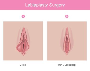 labiaplasty surgery. Illustration for medical use explain a procedure surgery to decrease the size of inner tissues the female genitalia clipart