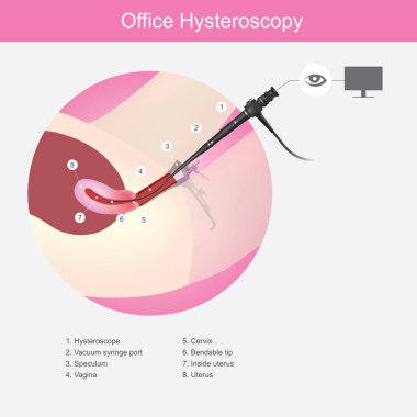 Office Hysteroscopy. Illustration showing the doctors use a micro camera (hysteroscope) insert passed a vagina into the uterus for diagnosis symptom clipart