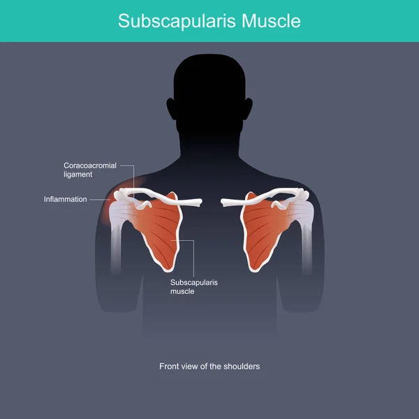 サブスカプラリス筋肉 医療用イラストは筋肉の炎症を正面から説明します — ストックベクタ