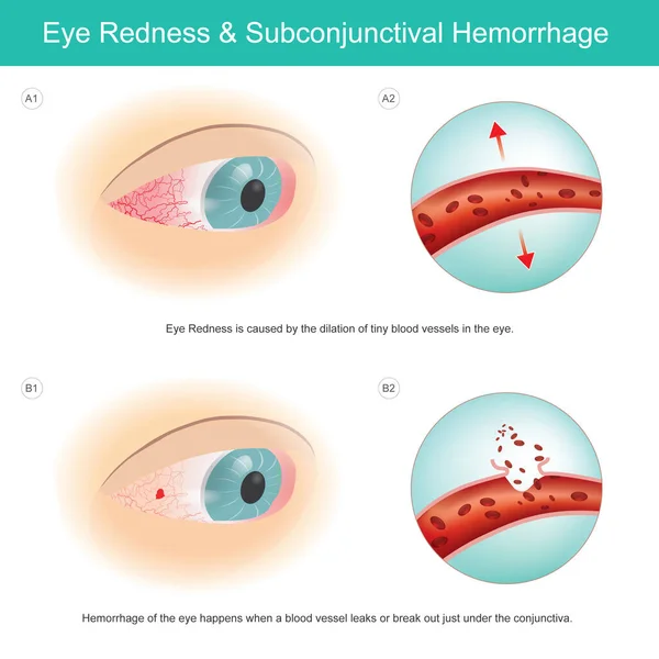 眼部红肿及结膜下出血 眼睛红是由于眼睛中微小的血管扩张引起的 当血管在结膜下漏出或破裂时 就会发生大出血 — 图库矢量图片
