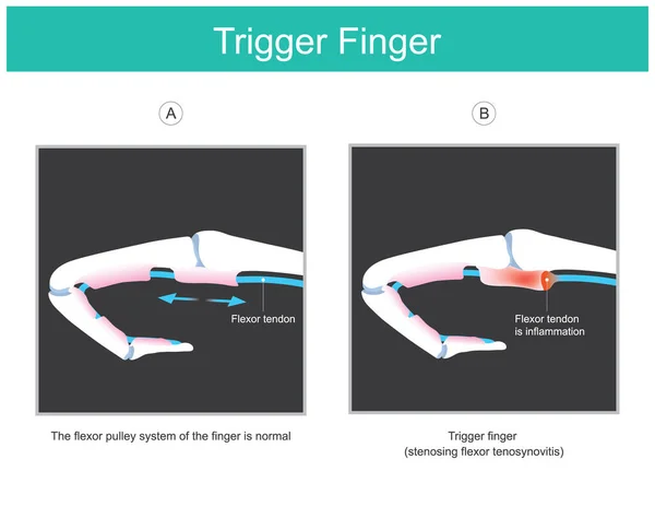 Een Triggervinger Illustratie Verklaren Een Symptoom Van Vergrendelde Vinger Veroorzaakt — Stockvector