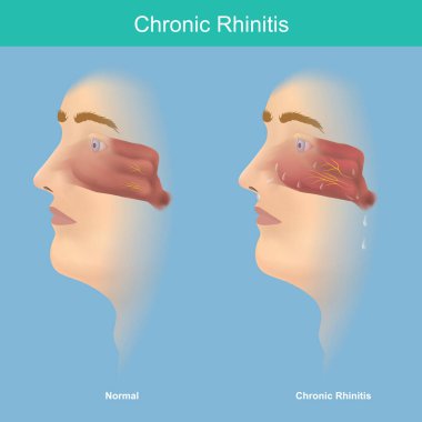 Kronik Rhinitis. Bu illüstrasyon tıbbi açıklamalarda kronik rhinitis semptomlarının burun ve boğazında mukus bulunur..