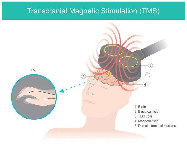 Transkraniyal Manyetik Uyarma (TMS). Değişen bir manyetik alanın elektrik akımına neden olduğu beyin uyarımı. Sağlık ve Tıbbi İllüstrasyon