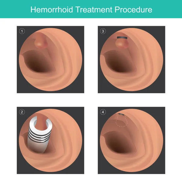 Hemorrhoid Treatment Procedure Illustration Medical Use Treatment Hemorrhoidal Rubber Banding — Stock Vector