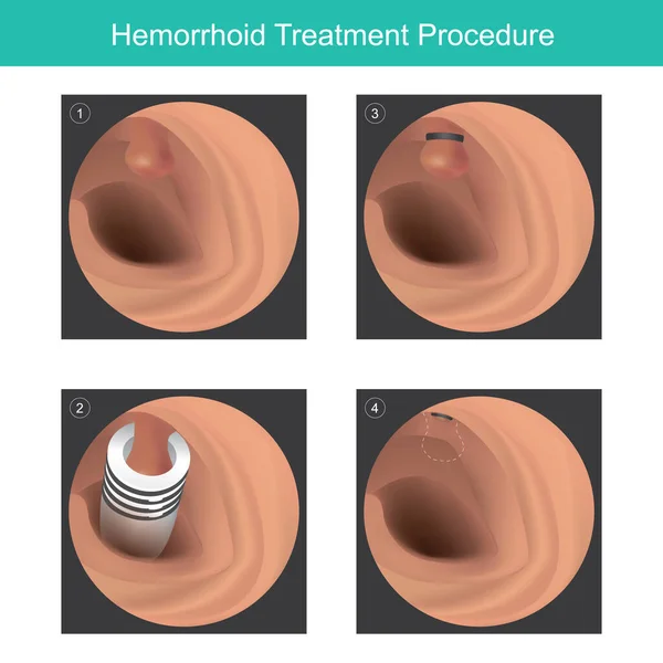 Procédure Traitement Des Hémorroïdes Illustration Pour Usage Médical Sur Traitement — Image vectorielle