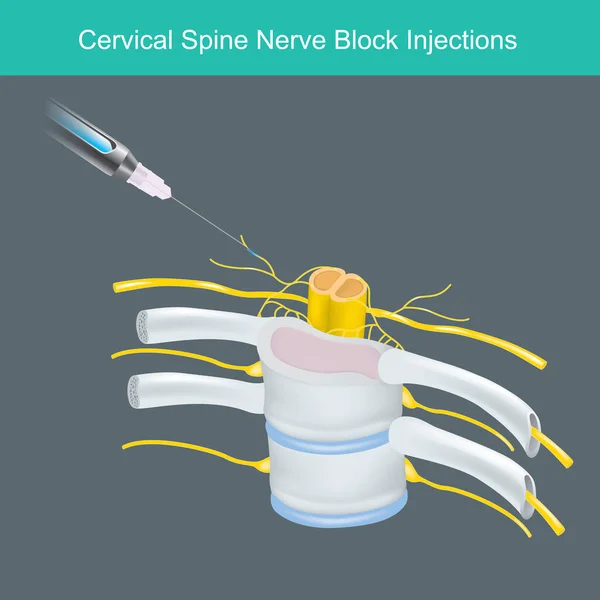 Injections Bloc Nerveux Colonne Cervicale Illustration Pour Apprentissage Solution Anesthésique — Image vectorielle