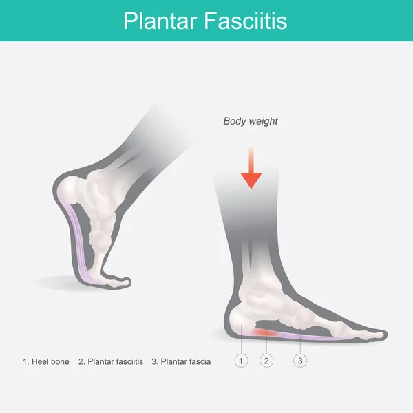 Fasciite Plantar Ilustração Anatomia Humano Explicar Sintomas Fascite Plantar —  Vetores de Stock