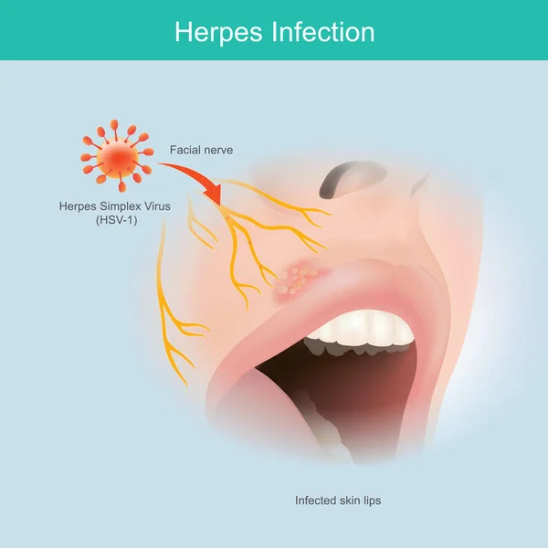 Infección Por Herpes Ilustración Piel Del Nervio Facial Humano Para — Vector de stock