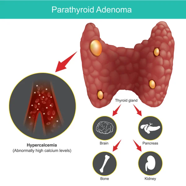 Adenoma Paratiroideo Ilustración Para Explicar Glándula Tiroides Anormal Incluir Efectos — Vector de stock